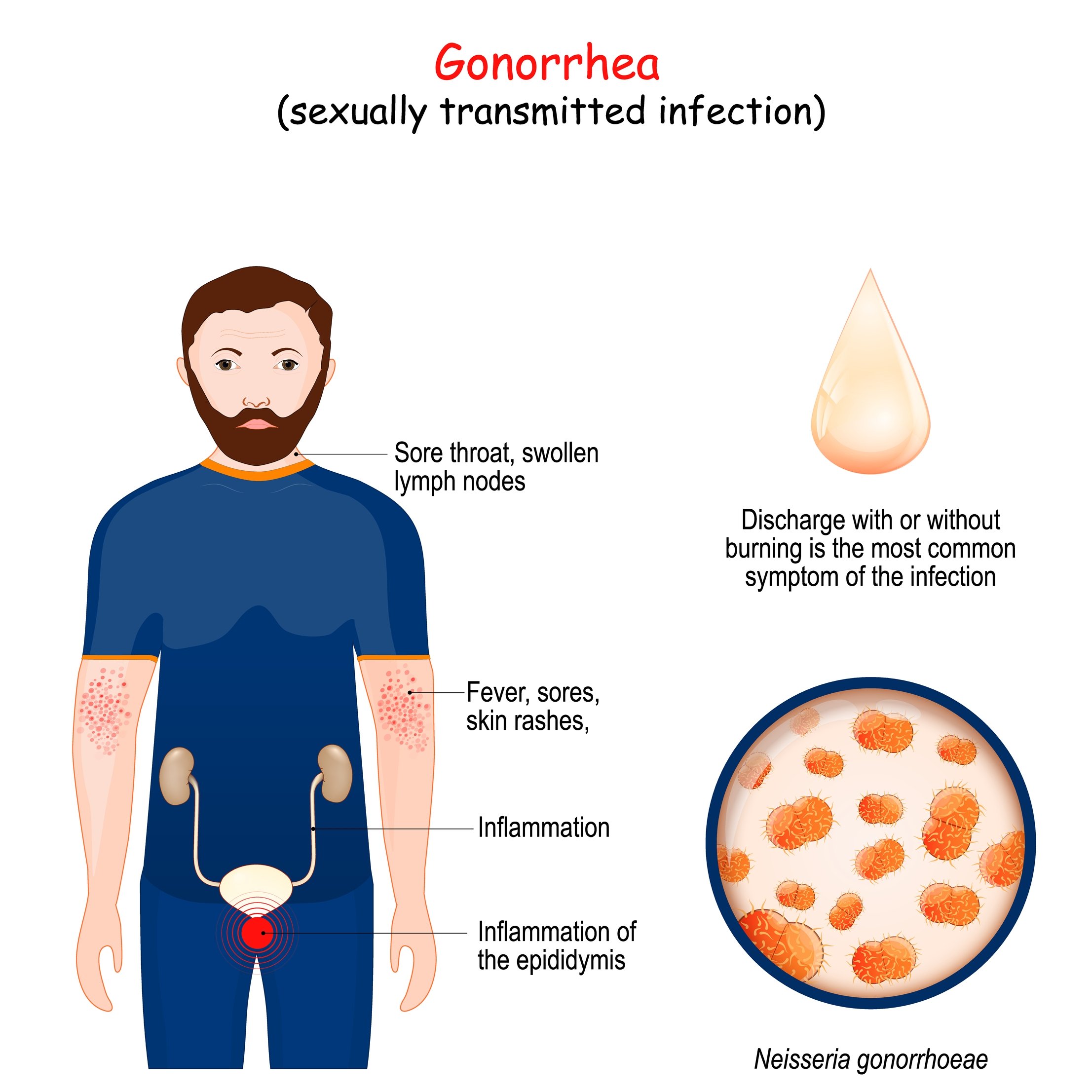 STD Testing: Gonorrhea