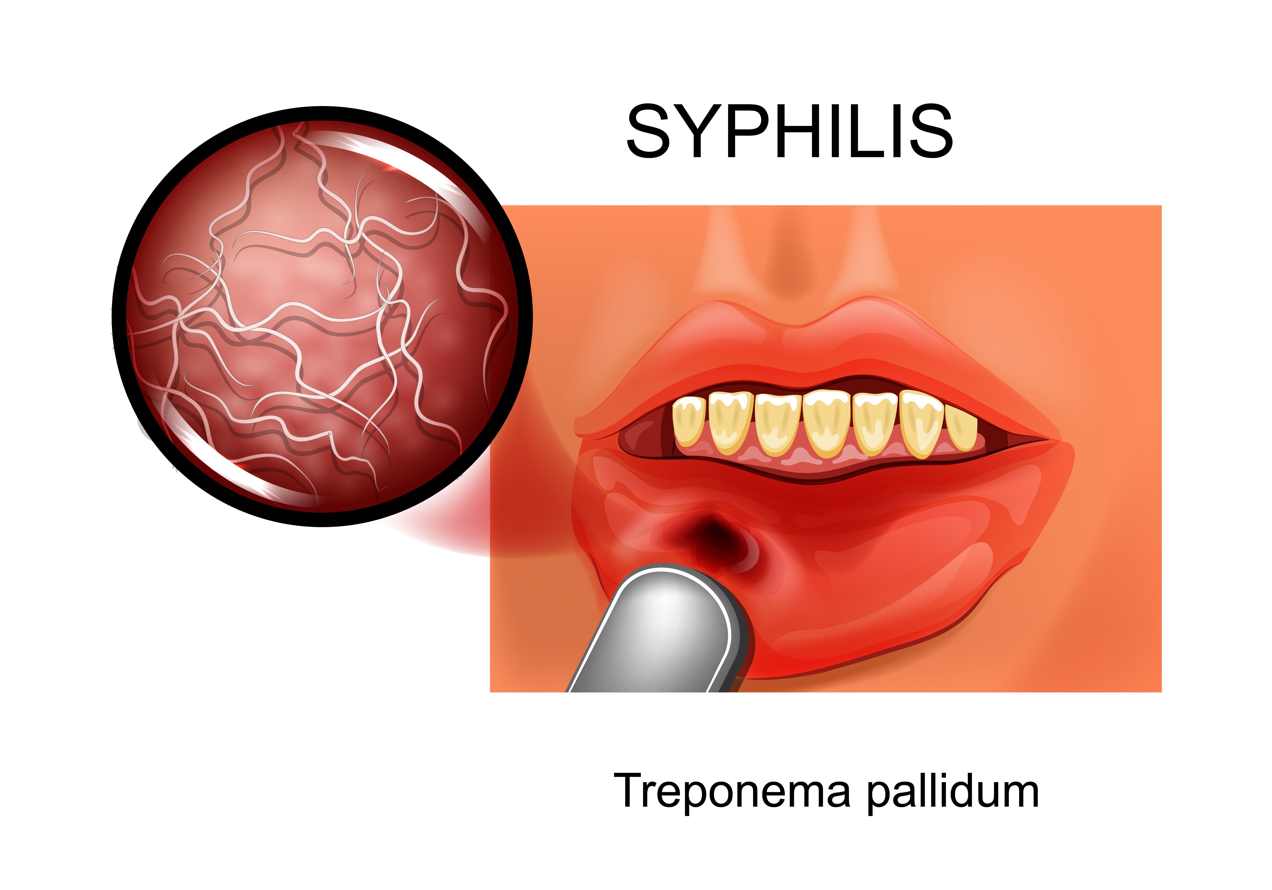 STD Testing: Syphilis (Treponema Pallidum)