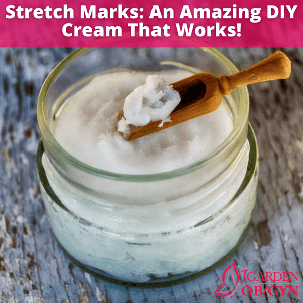 An Effective DIY Solution for Stretch Marks: Garden OBGYN: Obstetrics